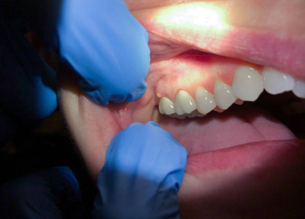 Best Emergency Treatment for Toothache in Apple Creek, OH